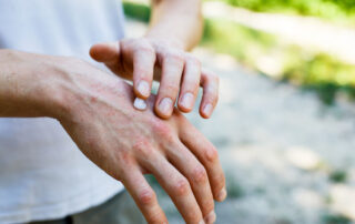 apthorp-rx-The-Power-Of-Compounding-Can-Your-Dermatologist-Prescribe-A-Custom-Medication-For-Psoriasis